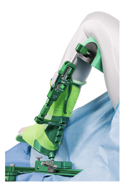 Transparent green prosthetic arm with mechanical joints and straps.